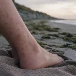 Piqure puces de sable sur mollet : petite papule rouge après la plage